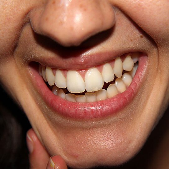 close up of smile with white spots